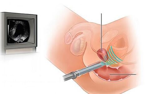 prostatas ultraskaņa