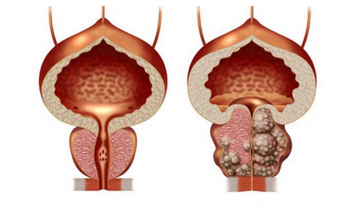 prostatas adenoma
